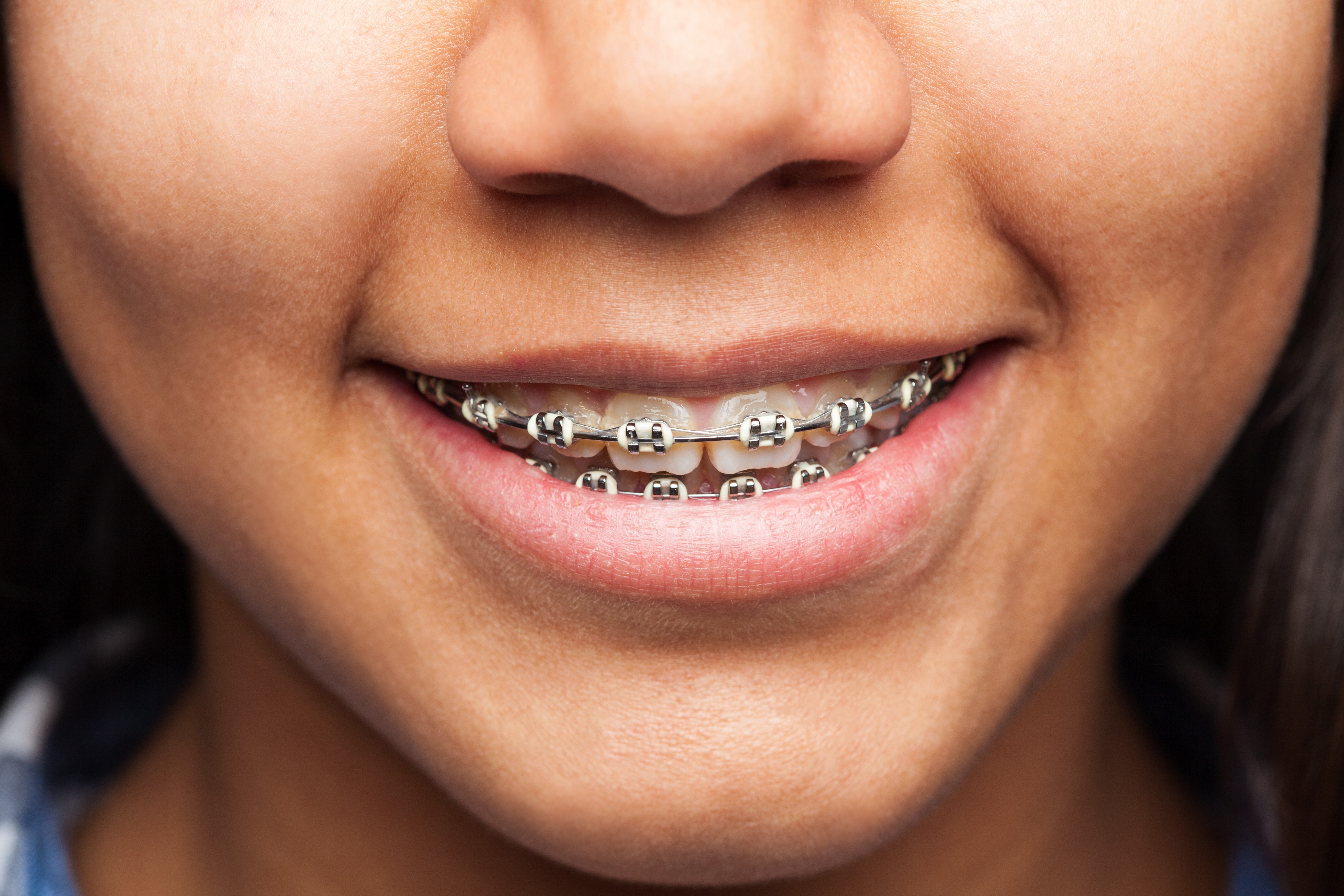Resultado ortodoncia sonrisa Quito
